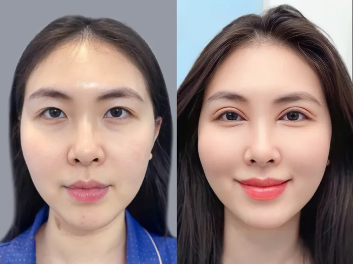 Khách hàng sở hữu nếp mí to tròn, cân đối khắc phục sụp mí, nhiều nếp mí