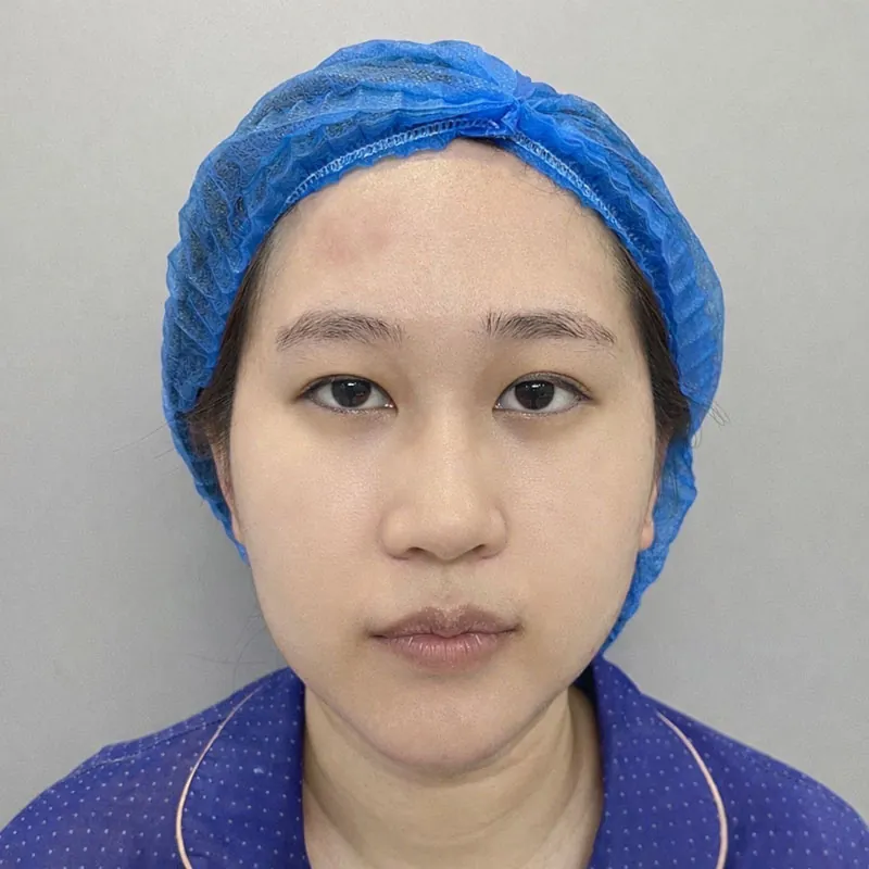 Quỳnh gặp tình trạng sụp mí bẩm sinh