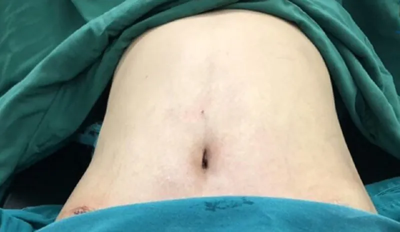 Hút mỡ bị lồi lõm da gồ ghề, sóng da hoặc lõm không đều do hút mỡ sai kỹ thuật, xơ hóa mô