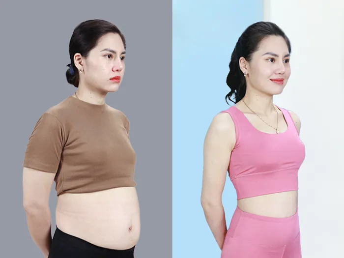 khách hàng trước và sau khi hút mỡ 1 tuần, đã ổn định cơ bản, cơ thể hồi phục tốt