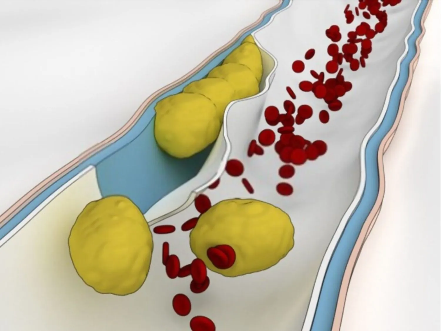 mô phỏng tình trạng Thuyên tắc mỡ, tình trạng này có thể gián tiếp làm ảnh hưởng đến các cơ quan nội tạng