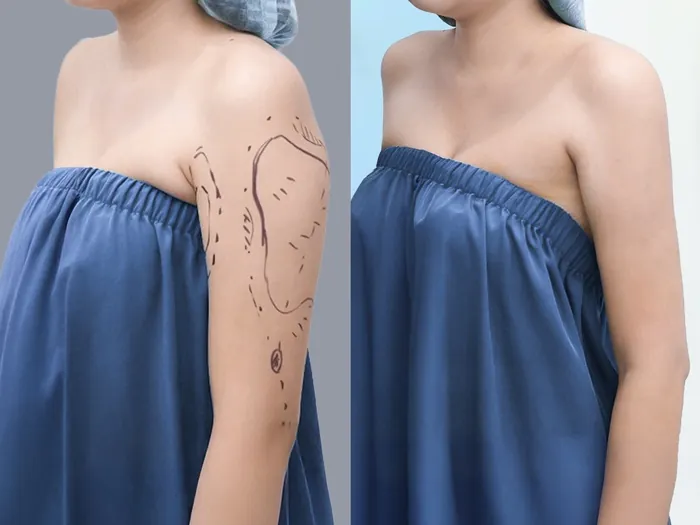 vùng bắp tay hồi phục nhanh chóng và ít bị sưng hơn 