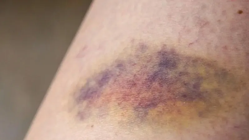 Hút mỡ bị sưng đau bất thường, không thuyên giảm sau vài ngày cần phải tái khám ngay để kiểm tra