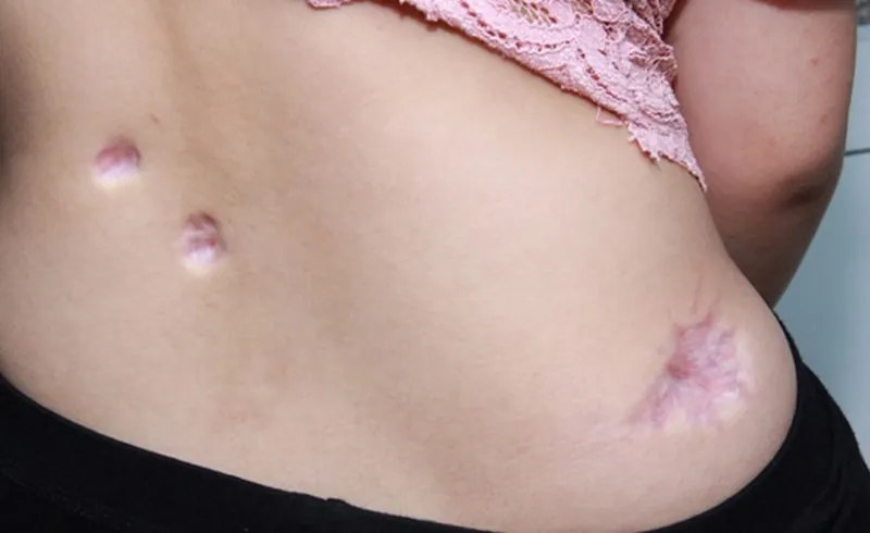 Xuất hiện sẹo lõm vùng bụng là biến chứng khi hút mỡ quá nhiều lần không an toàn gây ra