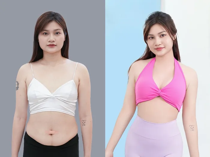 Cơ thể cân đối, đường nét rõ ràng sau khi hút mỡ toàn thân