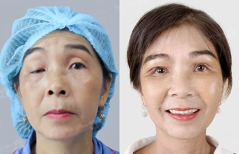 Kết quả cắt mí mắt cải thiện tình trạng sụp mí nhẹ do da chùng ở người trẻ tuổi.