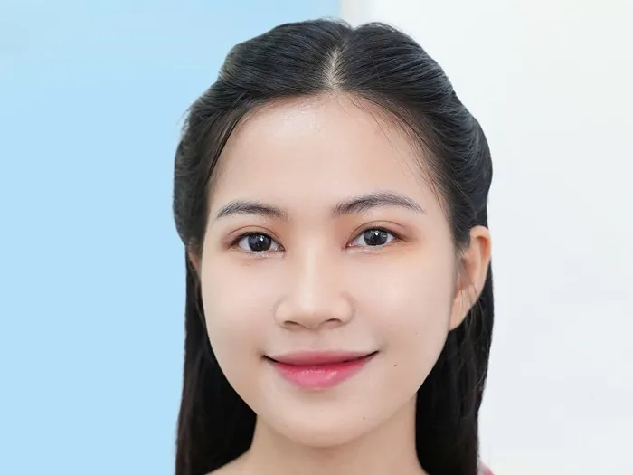 Nếp mí rõ, nhìn hài hòa không để lại sẹo và trông rất tự nhiên