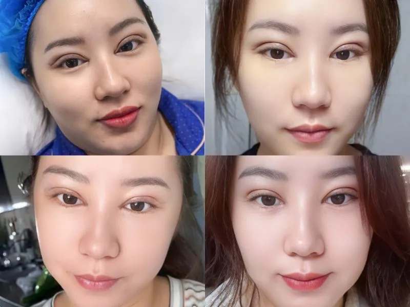 Nếp mí sau cắt hồi phục theo từng giai đoạn từ hơi sưng đau đến hoàn toàn lành, mờ sẹo và trông tự nhiên nhất