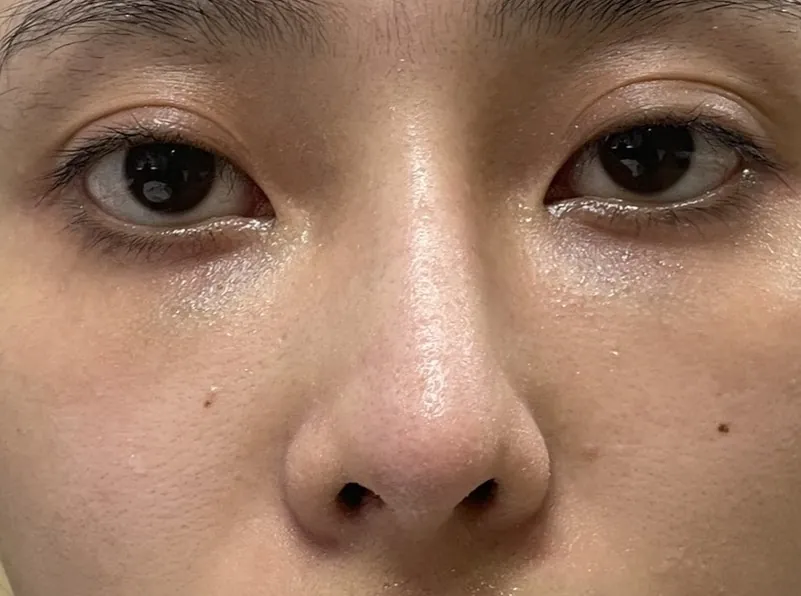 Tình trạng nhìn sống mũi hoặc đầu mũi không nằm trên trục thẳng khuôn mặt.