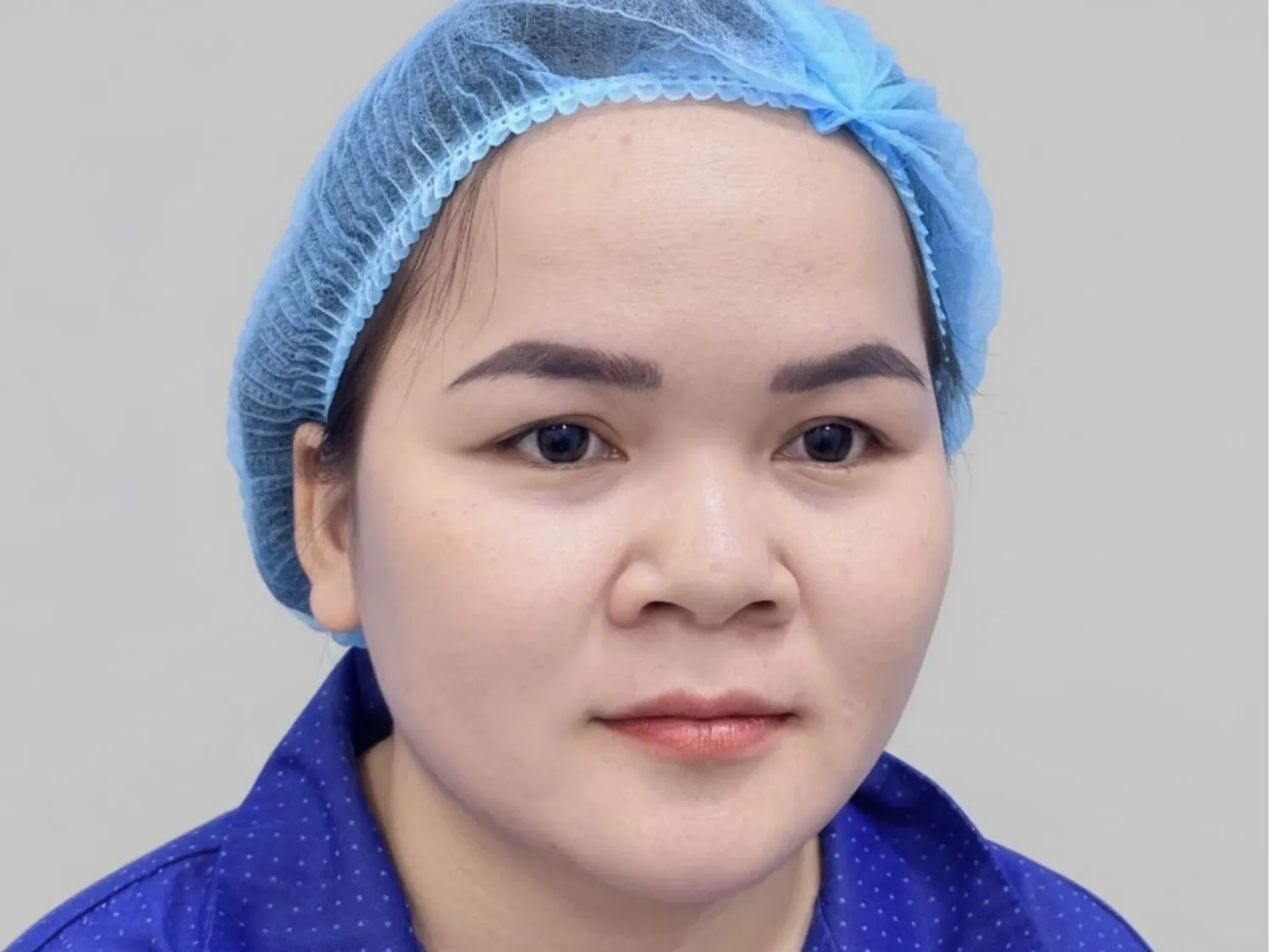 khách hàng gặp tình trạng mũi, sống mũi ngắn, đầu mũi hướng lên trên khiến lỗ mũi bị lộ rõ khi nhìn trực diện