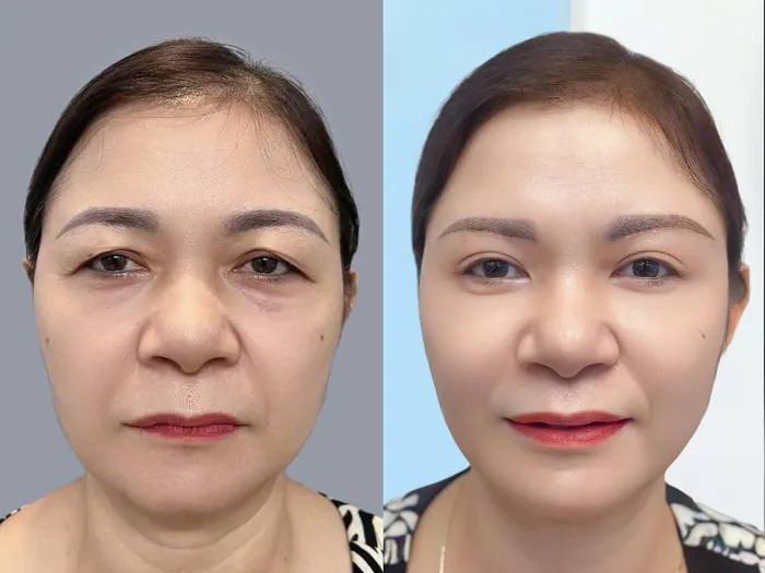 khách hàng lớn tuổi có nhiều da mí chùng, mỡ thừa vùng mắt, sau khi cắt mí như trẻ ra 10 tuổi, mí đều và gương mặt thanh thoát hơn
