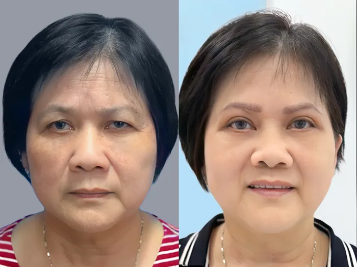 ảnh so sánh khách hàng trước và sau khi cắt mí, tầm nhìn được cải thiện rõ rệt, mắt to và sáng hơn