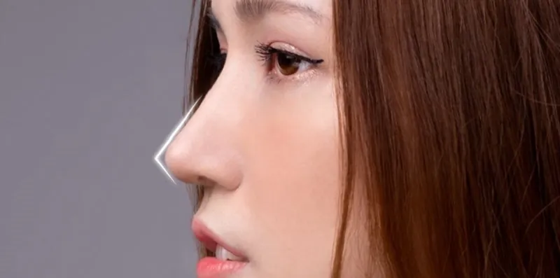 Mô phỏng cấu trúc mũi L-line với sống mũi thẳng từ gốc mũi đến đầu mũi, tạo hình góc mũi môi chuẩn 90-95 độ phong cách hiện đại.