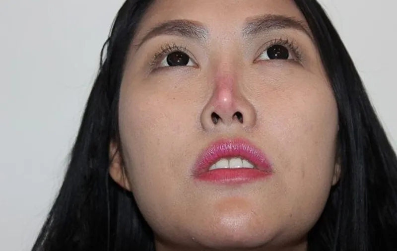 Biến chứng viêm sưng đỏ đầu mũi sau khi nâng cần xử lý sớm để tránh nguy hiểm