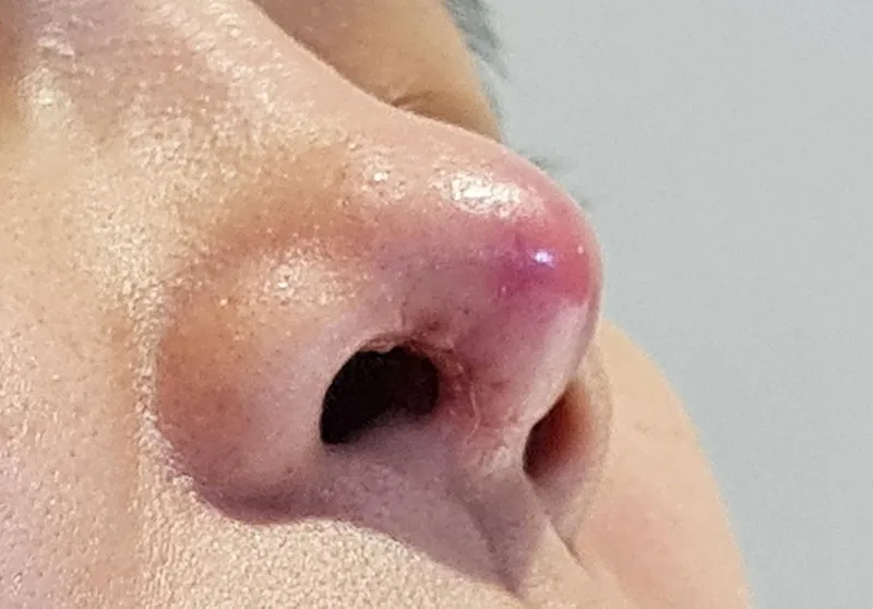mũi lộ sống, bóng đỏ là biến chứng cần được can thiệp