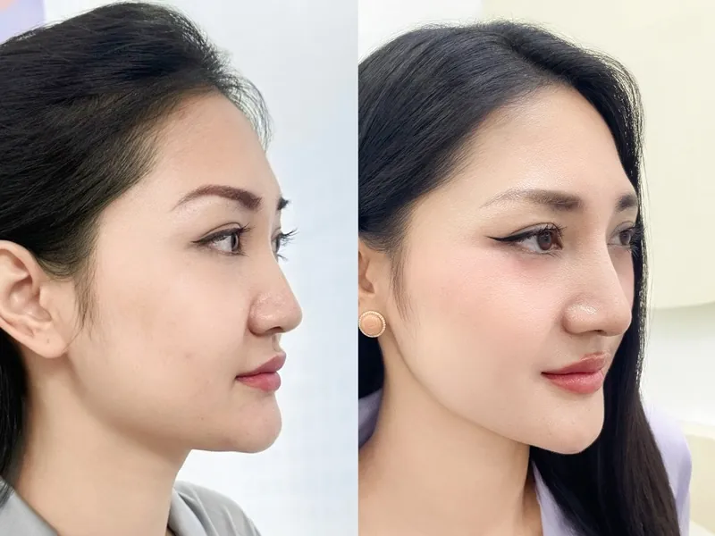 Hình ảnh lỗ mũi hình hạt chanh cân đối và vết mổ mờ hoàn toàn sau khi nâng mũi