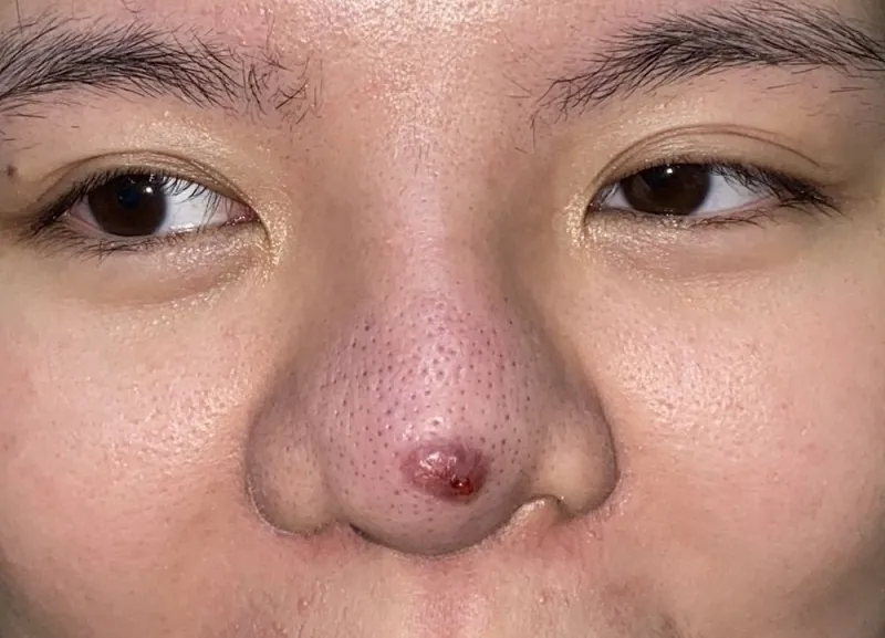 Dấu hiệu mũi tụ dịch, đầu mũi sưng tấy kéo dài