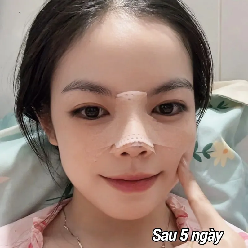 Mũi sưng nề tự nhiên, giảm sưng sau nâng mũi 5 ngày