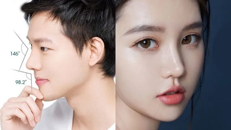 So sánh kỹ thuật nâng mũi S-line bọc sụn và nâng mũi cấu trúc toàn diện về mức độ can thiệp