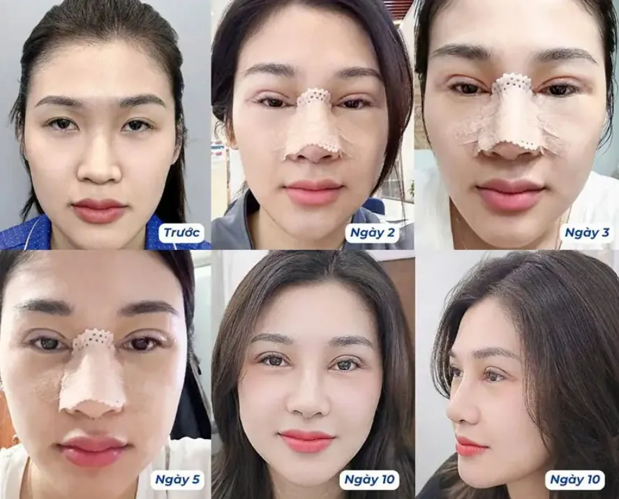 Nâng mũi trải qua nhiều giai đoạn từ chuẩn bị đến hồi phục lên form mũi chuẩn, tự nhiên