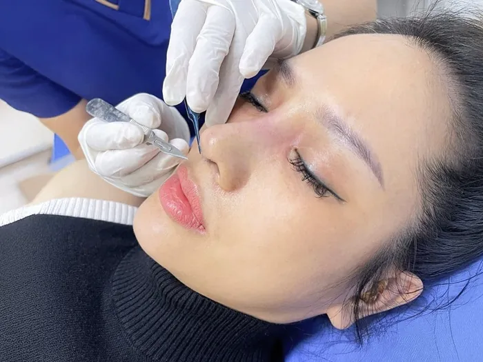 Tùy thuộc tình trạng mũi hỏng, nhiều sẹo hay không mà thời gian nâng mũi sẽ lâu hơn bình thường