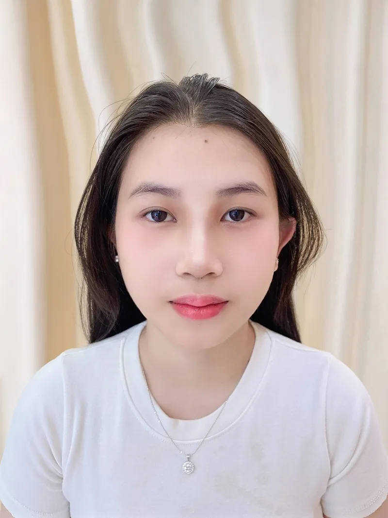 Trước và sau nâng mũi cấu trúc - khách hàng Thu Trang, dáng mũi cao tự nhiên sau 5 ngày, BS Nguyễn Quốc Chí