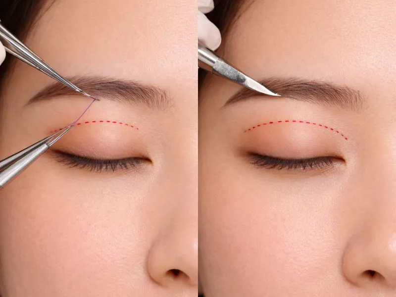 Sự khác biệt về độ dài đường rạch giúp Mini Deep giảm thiểu sưng bầm và hồi phục nhanh hơn.