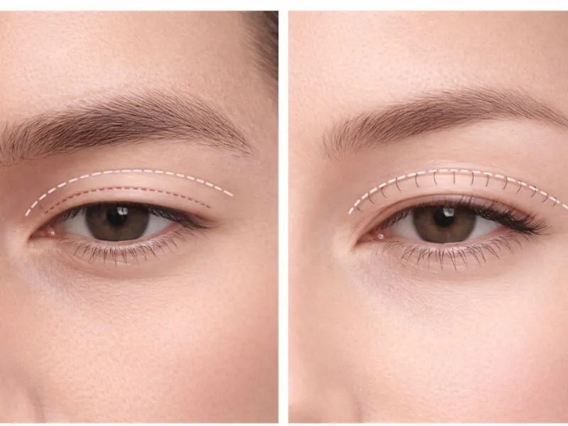 Sự khác biệt về cấu trúc xương và da mí mắt giữa nam và nữ ảnh hưởng trực tiếp đến kỹ thuật tạo hình nếp mí.