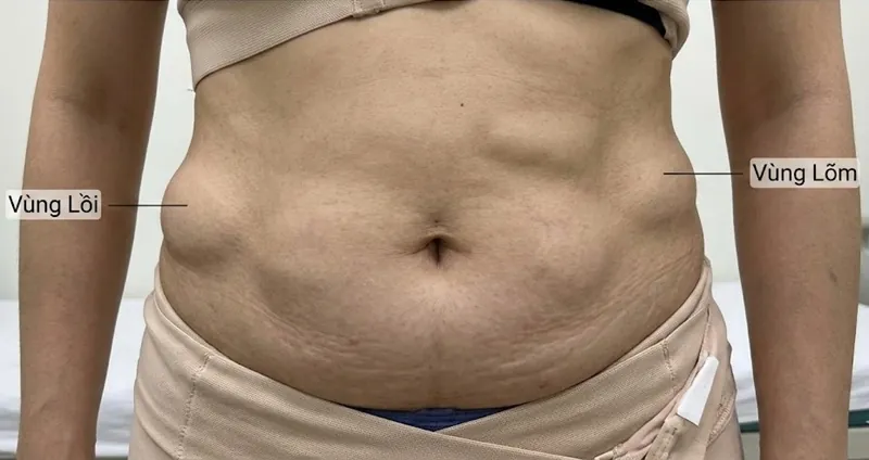 Bề mặt hút mỡ chỗ lồi, chỗ lõm mất thẩm mỹ, không cân đối vùng bụng cơ thể