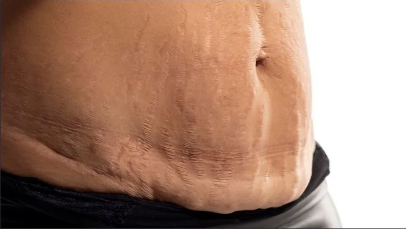 Người có vùng da bụng ngăn nheo chảy xệ cần hút mỡ lại để giúp bụng phẳng, lấy lại vóc dáng tự nhiên hoàn hảo