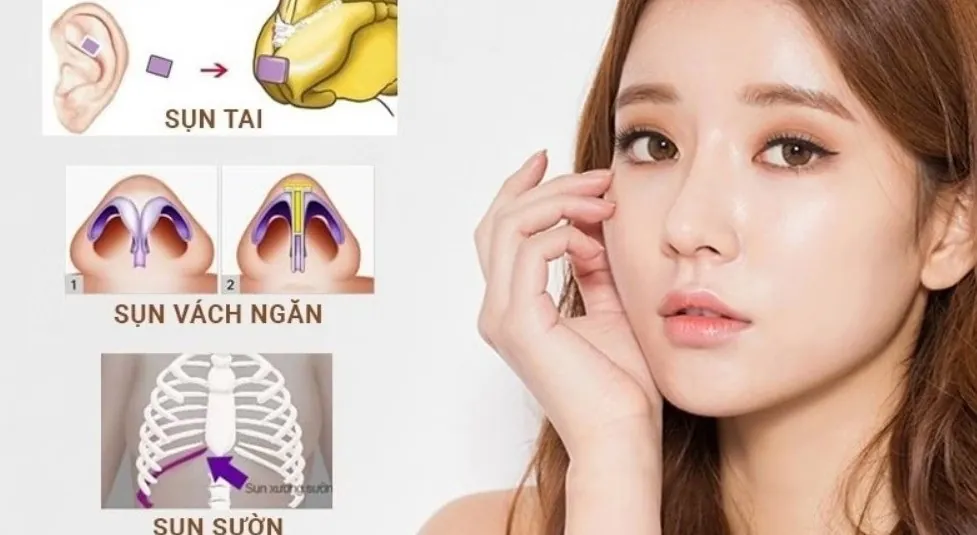 Sơ đồ vị trí lấy sụn tai, sụn sườn và sụn vách ngăn dùng trong phẫu thuật nâng mũi cấu trúc.