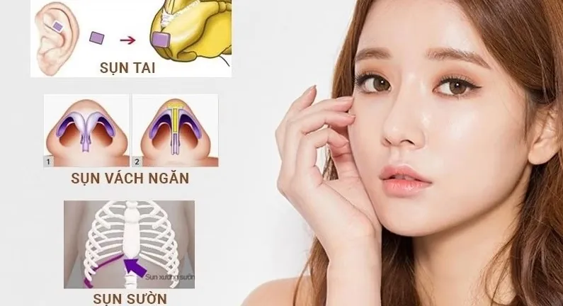 Cấu trúc các loại sụn tự thân trong nâng mũi thẩm mỹ bao gồm sụn vành tai, sụn vách ngăn và sụn sườn giúp tương thích sinh học tối đa.
