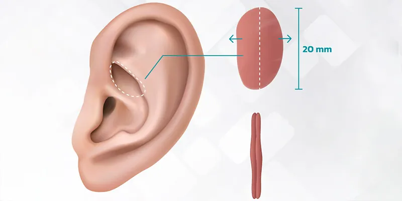 Ứng dụng sụn tự thân trong việc dựng trụ mũi vững chãi và bao bọc đầu mũi tạo độ bay tự nhiên cho dáng mũi.