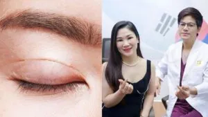 Tái khám sau cắt mí