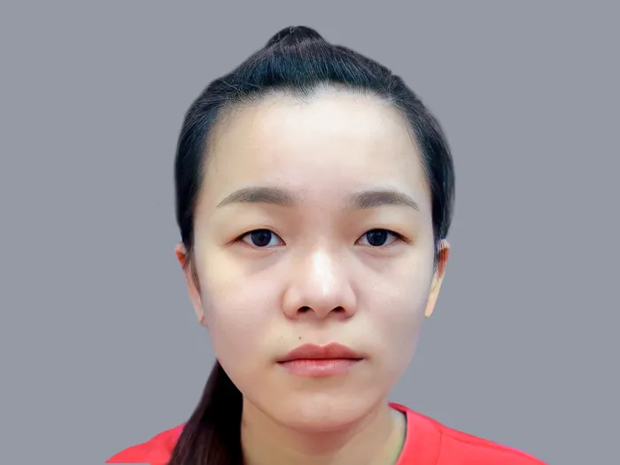 tình trạng mắt 1 mí nên cân nhắc cắt mí để gương mặt sắc nét và có chiều sâu