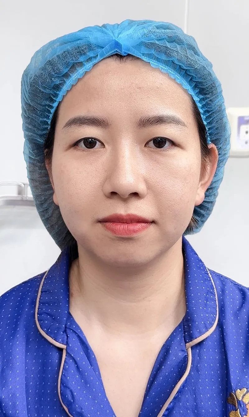 Tình trạng sụp mí do yếu cơ nâng mi, da thừa