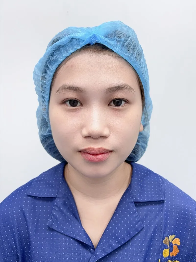 Tình trạng mũi thấp, sống mũi không rõ