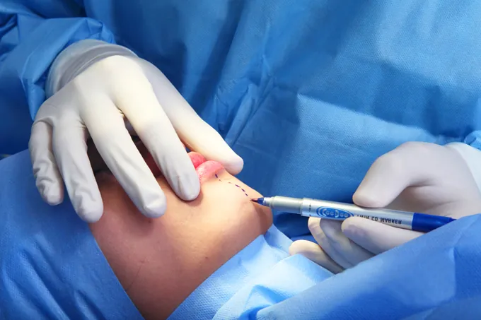 Vị trí đánh dấu để thực hiện độn cằm