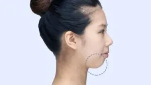 Cằm ngắn nên làm gì? Cách cải thiện cằm lẹm và chọn phương pháp phù hợp