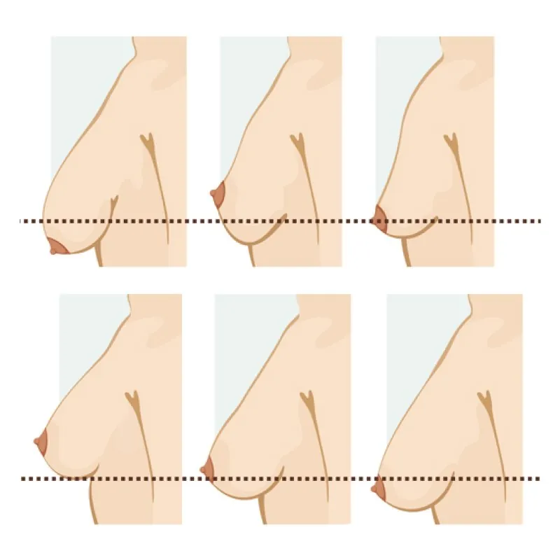 Sơ đồ giải phẫu mô tuyến vú bị teo nhỏ và dây chằng Cooper bị giãn sau khi cai sữa gây sa trễ]