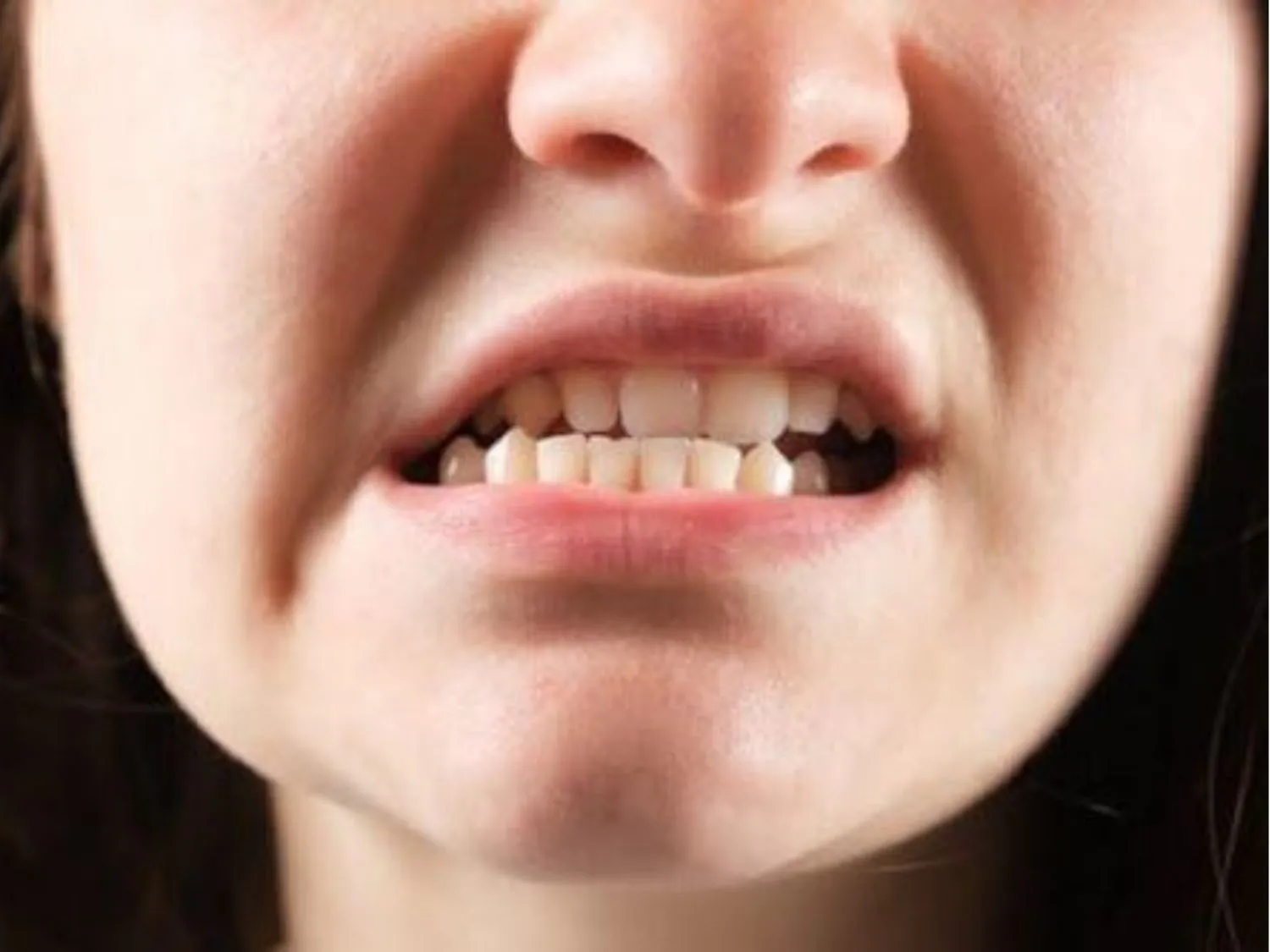 Sai lệch khớp cắn do chỉnh hàm sai kỹ thuật ảnh hưởng tới phát âm