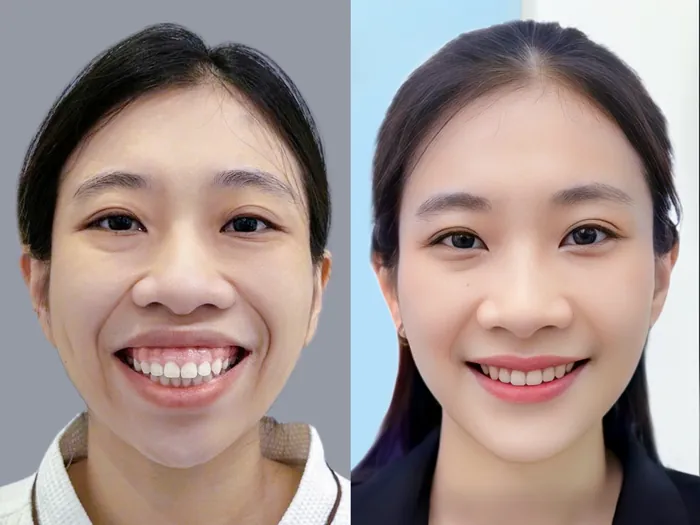 Khách hàng bị hô do hàm nặng, cần phẫu thuật chỉnh hàm