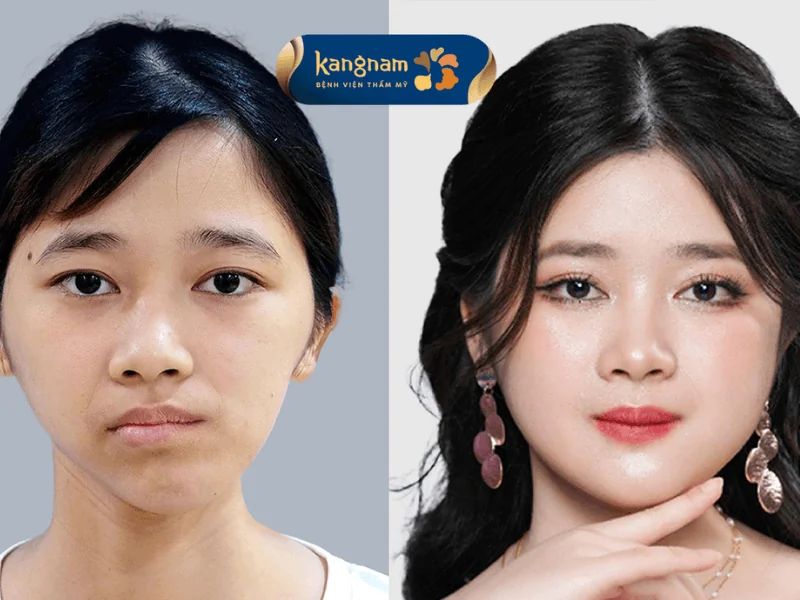Trường hợp lệch hàm nặng cần phải phẫu thuật sẽ mang lại kết quả tốt và an toàn