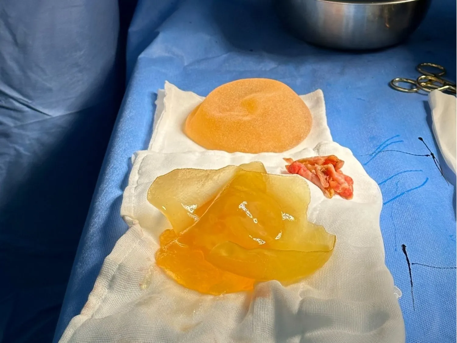 đây là tình trạng túi ngực bị bao xơ sau khi lấy ra ngoài cơ thể