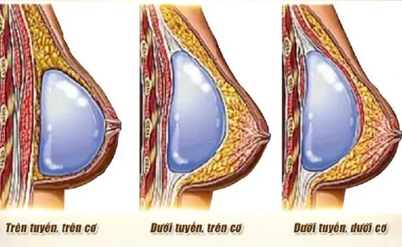 Các vị trí đặt túi ngực được áp dụng