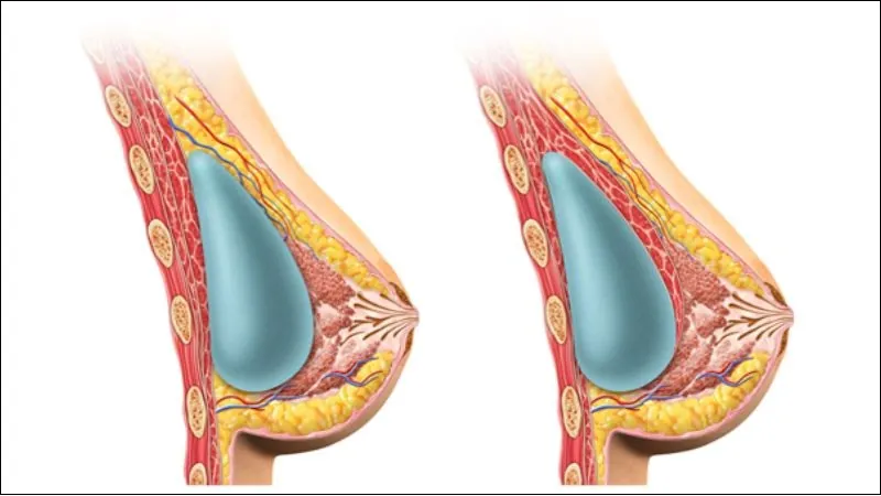 Kỹ thuật đặt túi dưới cơ (Dual Plane) giúp cách ly hoàn toàn túi độn với tuyến sữa.