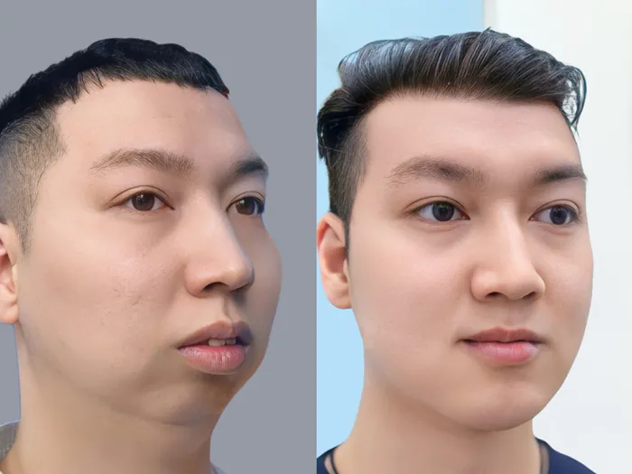 Khách hàng Kangnam sở hữu dáng cằm cân đối, an toàn sau độn cằm