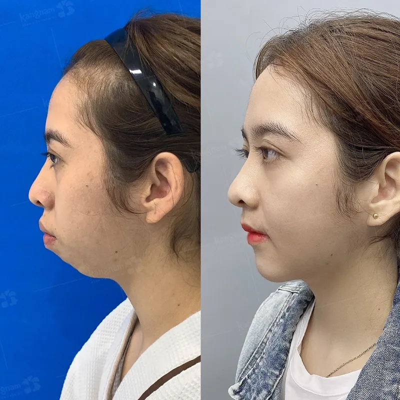 Trường hợp cằm ngắn được chỉ định độn cằm để làm khuôn mặt cân đối hơn
