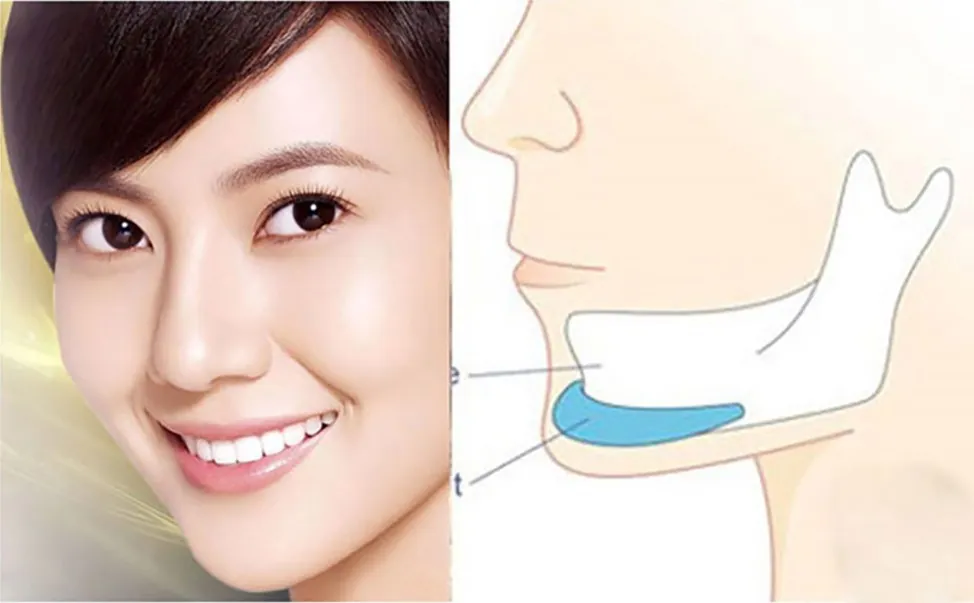 Minh họa sự khác biệt giữa việc đặt vật liệu nhân tạo và tái cấu trúc xương thật trong độn cằm.