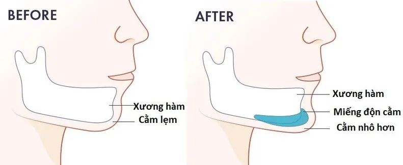 Khoang đặt sụn phải được bóc tách vừa khít để tránh tình trạng sụn "trôi" tự do.
